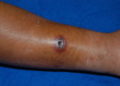 Anthrax Outbreak: Sierra Leone records first human cases