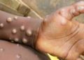 Sierra Leone denies WHO report of Monkeypox cases