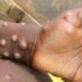 Sierra Leone denies WHO report of Monkeypox cases