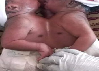 Liberia: Woman gives birth to conjoined twins
