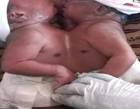 Liberia: Woman gives birth to conjoined twins