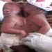 Liberia: Woman gives birth to conjoined twins