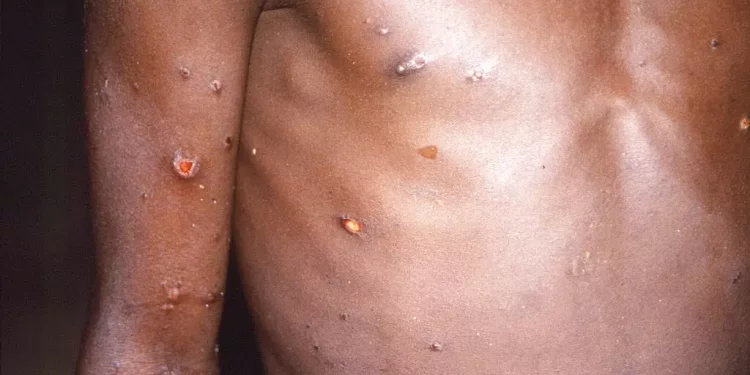 Liberia announces first Monkeypox case in three years