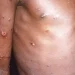 Liberia announces first Monkeypox case in three years