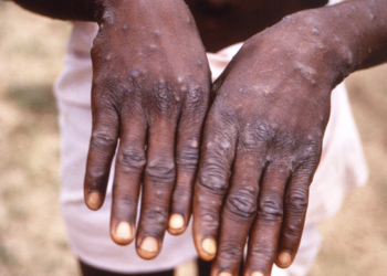 A patient afflicted by Mpox. Image, US CDC