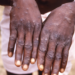 A patient afflicted by Mpox. Image, US CDC