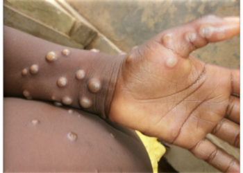 An Mpox case. Image, WHO.
