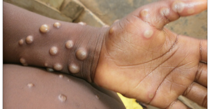 An Mpox case. Image, WHO.