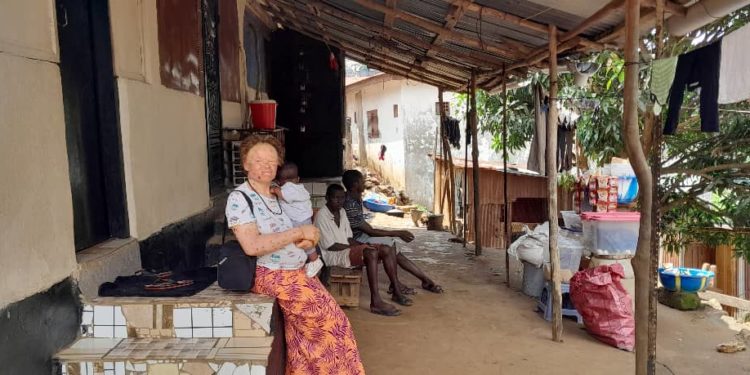 Mariatu Kamara, with her son, has undergone surgery twice due to skin condition common to persons with albinism. Image, Kemo Cham, ManoReporters.